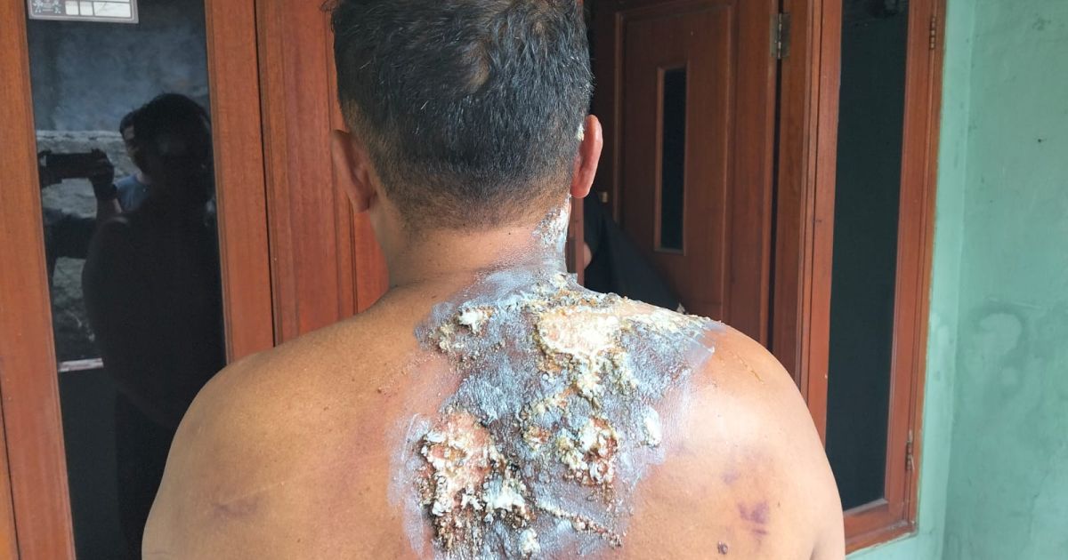 Seorang Pekerja Menderita Luka Sobek dan Luka Bakar Diduga Korban Hukum Jalanan